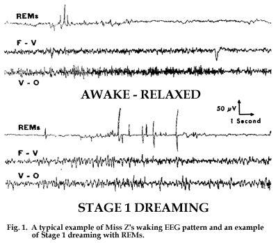 Figure 1. Un exemple typique de tracé EEG d'éveil de Miss Z et un exemple de rêve de phase I avec des MOR.