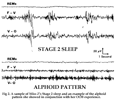 Figure 2. Un exemple de sommeil de phase II de Miss z et un exemple du pattern alphoïde qu'elle a présenté en conjonction avec son OBE.